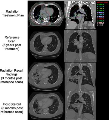 Radiation Recall Pneumonitis After Treatment With Checkpoint Blockade Immunotherapy: A Case Series and Review of Literature